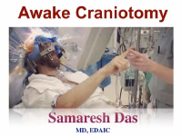 Awake craniotomy ..pdf